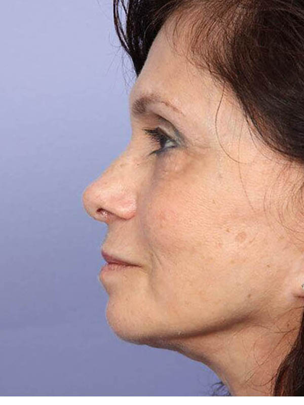 Rhinoplasty Before & After Image