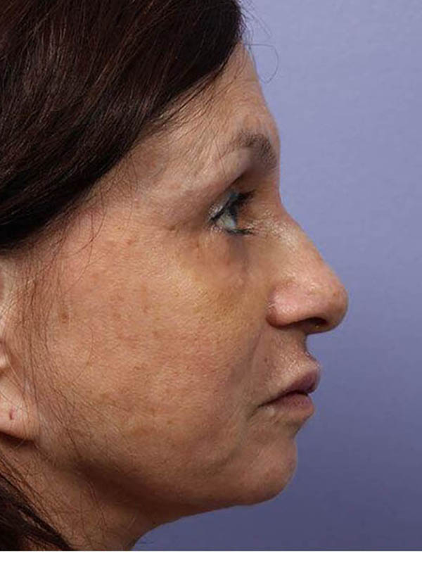 Rhinoplasty Before & After Image