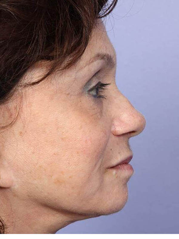 Rhinoplasty Before & After Image