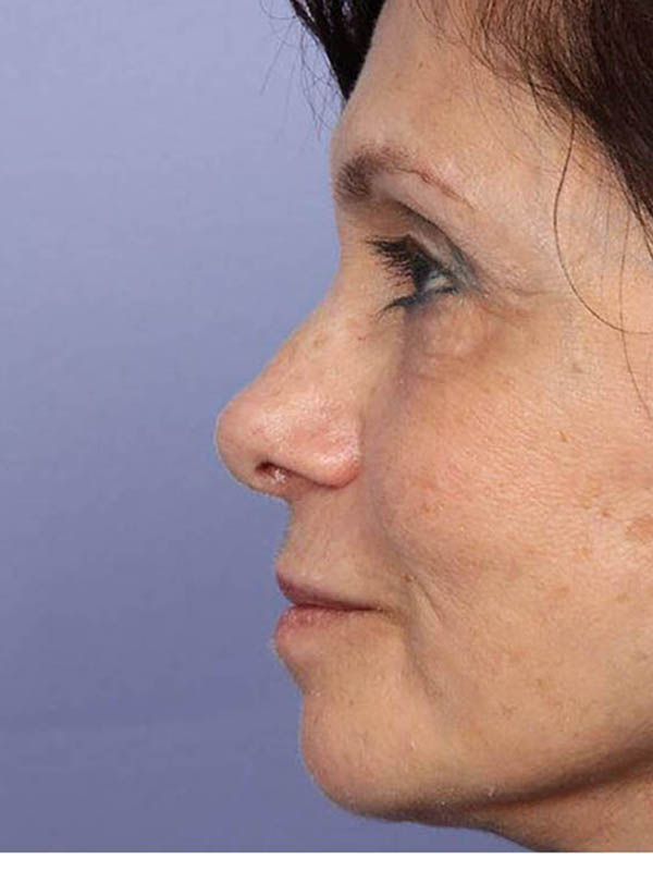 Rhinoplasty Before & After Image