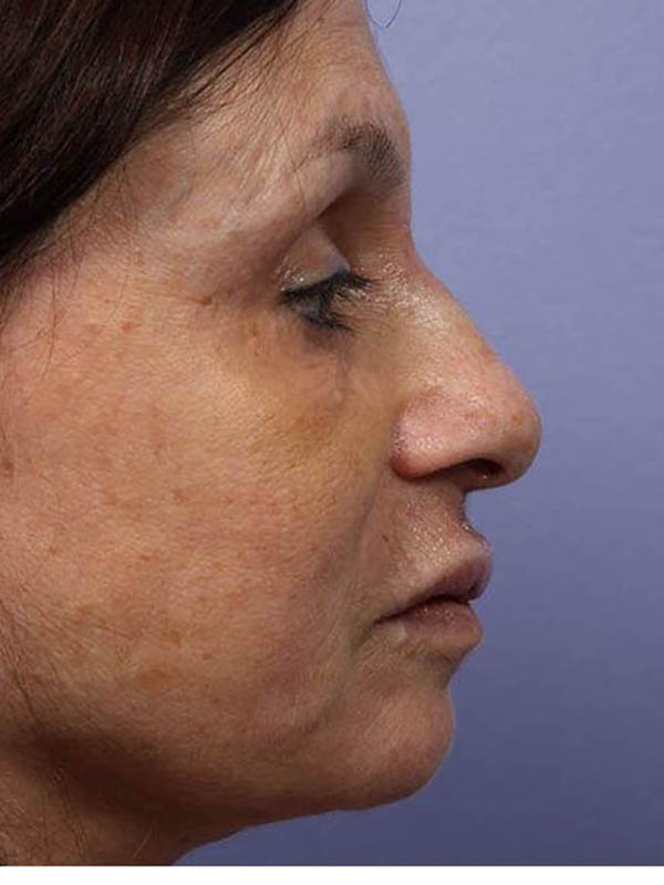 Rhinoplasty Before & After Image