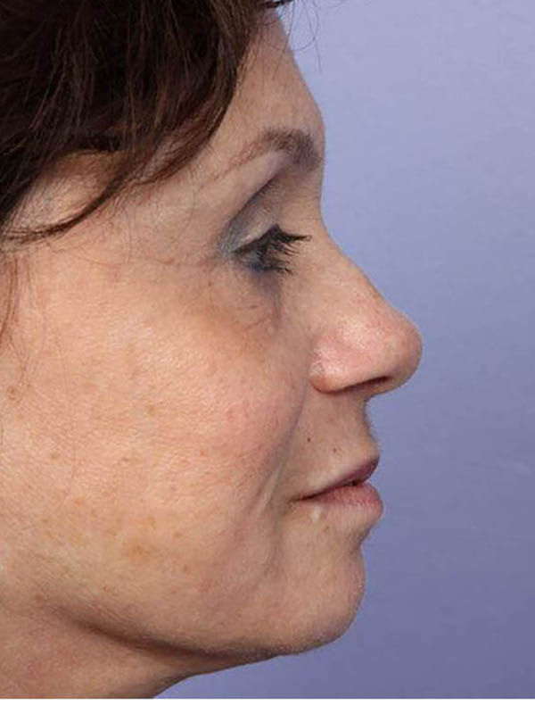 Rhinoplasty Before & After Image