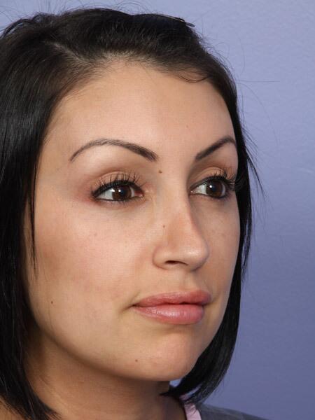 Rhinoplasty Before & After Image