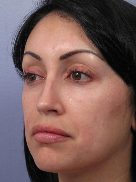 Rhinoplasty Before & After Image