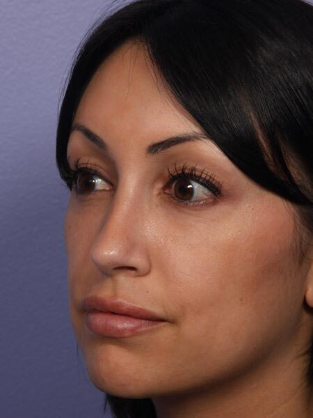 Rhinoplasty Before & After Image