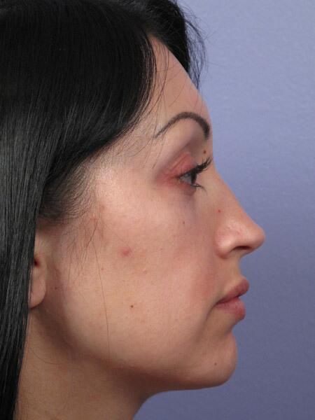 Rhinoplasty Before & After Image