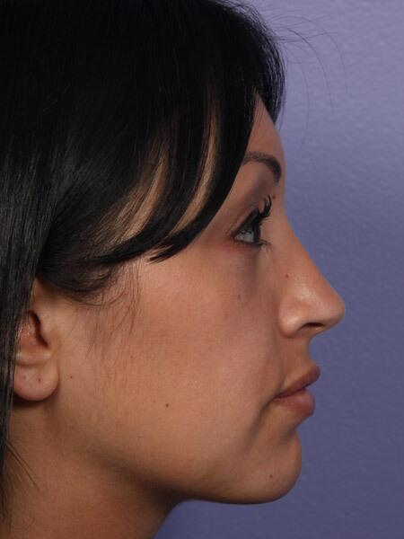 Rhinoplasty Before & After Image