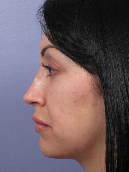 Rhinoplasty Before & After Image