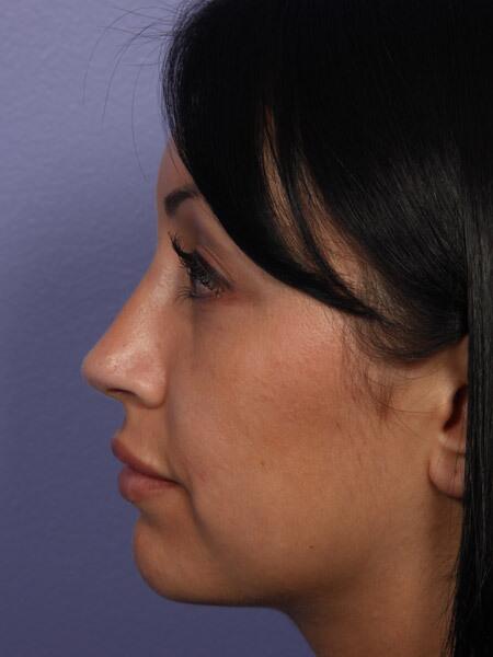 Rhinoplasty Before & After Image