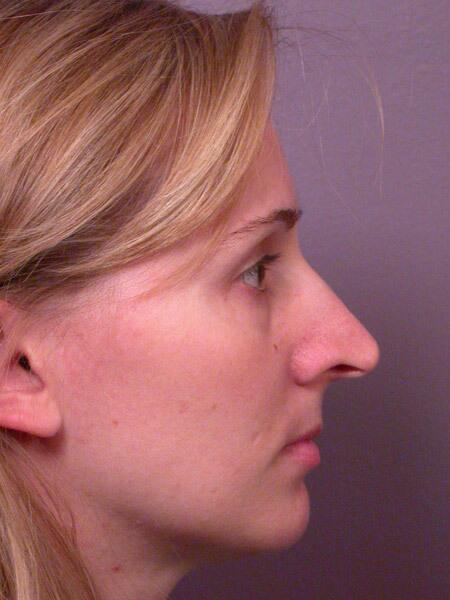 Rhinoplasty Before & After Image