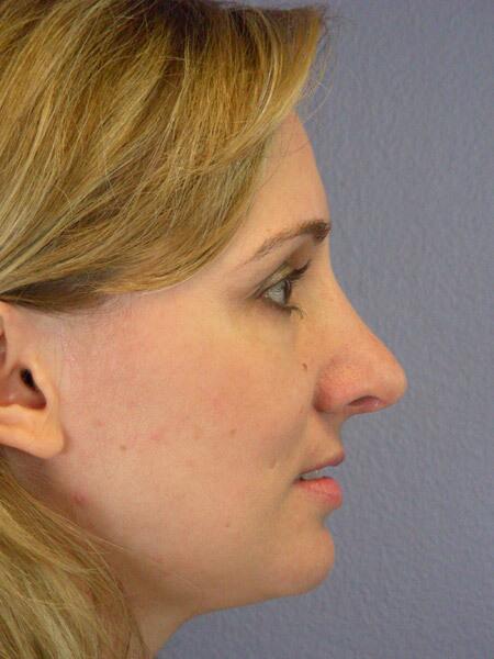 Rhinoplasty Before & After Image