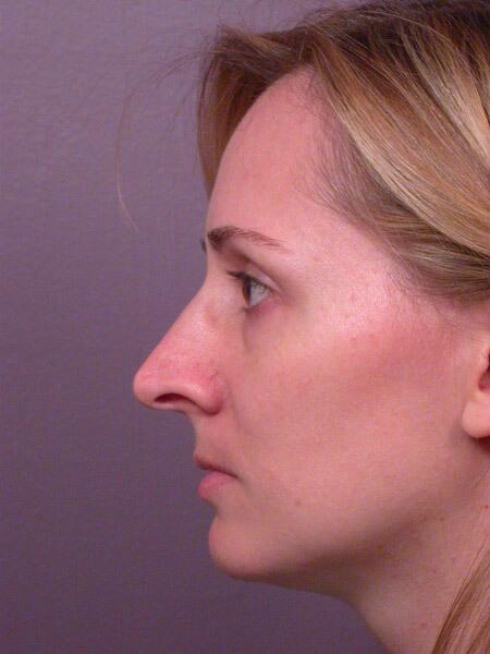 Rhinoplasty Before & After Image