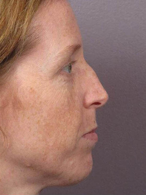 Rhinoplasty Before & After Image