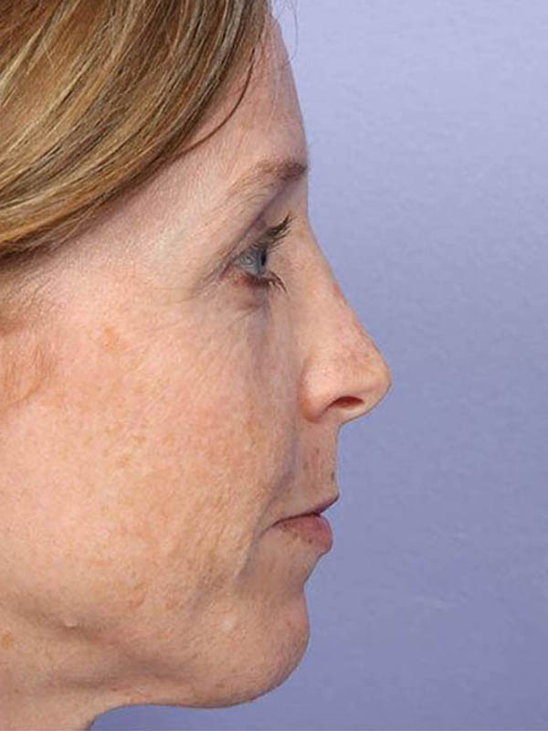 Rhinoplasty Before & After Image