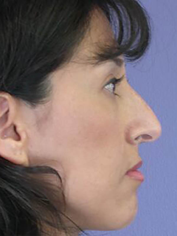 Rhinoplasty Before & After Image