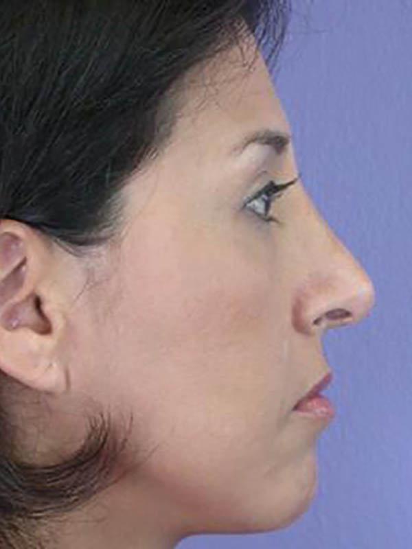 Rhinoplasty Before & After Image