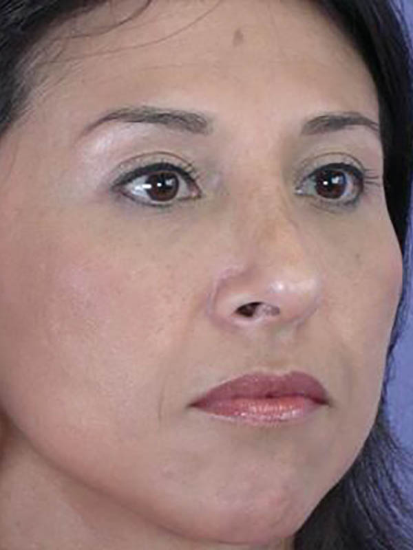 Rhinoplasty Before & After Image