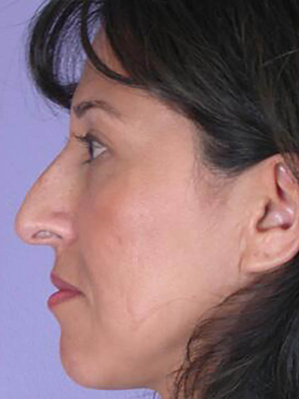 Rhinoplasty Before & After Image