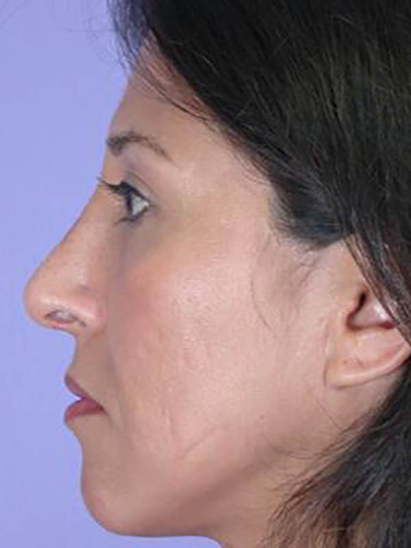 Rhinoplasty Before & After Image