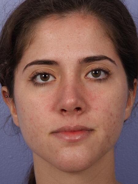 Rhinoplasty Before & After Image