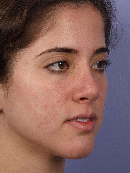 Rhinoplasty Before & After Image