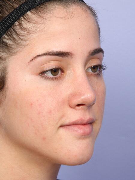 Rhinoplasty Before & After Image