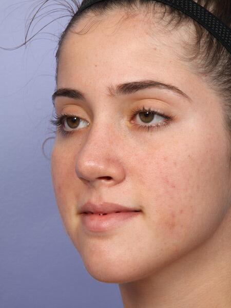 Rhinoplasty Before & After Image