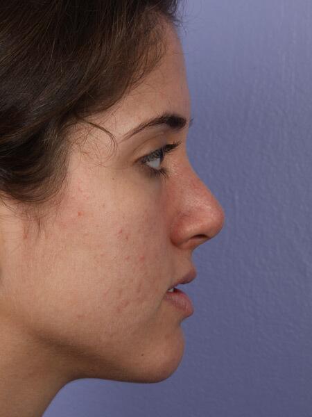 Rhinoplasty Before & After Image