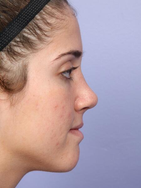 Rhinoplasty Before & After Image