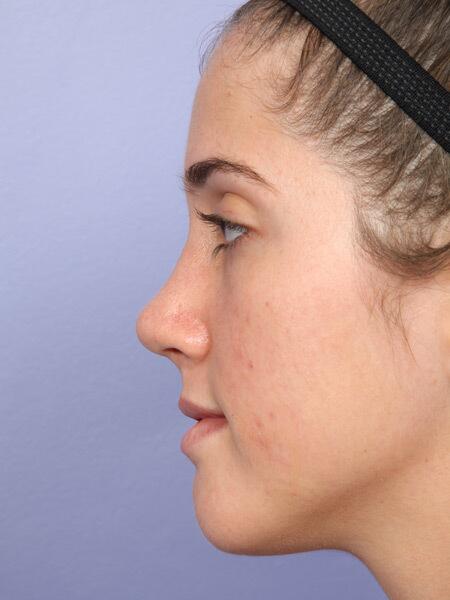 Rhinoplasty Before & After Image