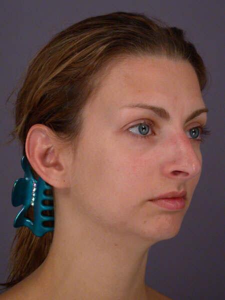 Rhinoplasty Before & After Image