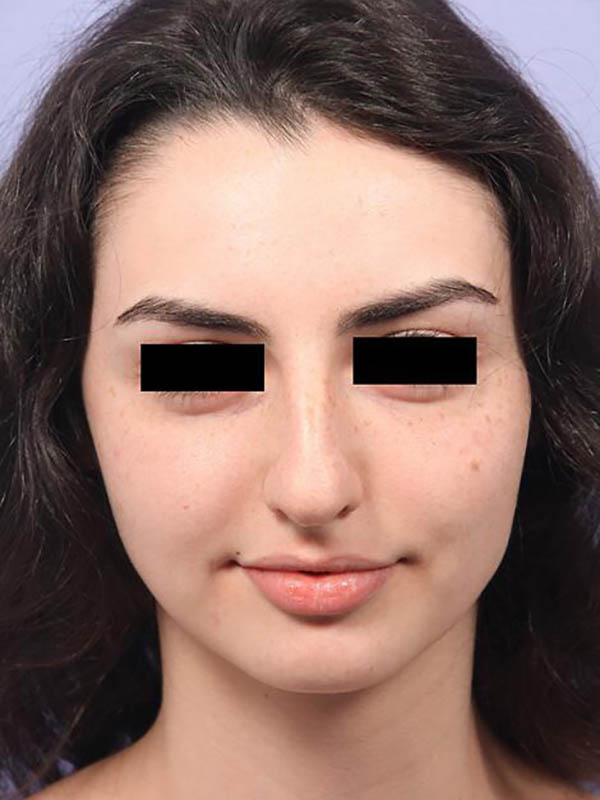 Rhinoplasty Before & After Image