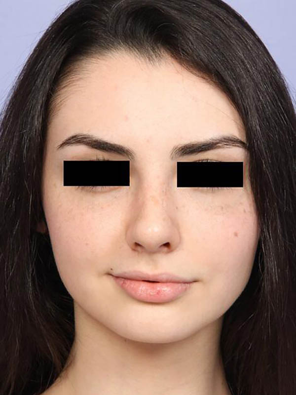 Rhinoplasty Before & After Image