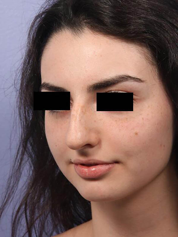 Rhinoplasty Before & After Image