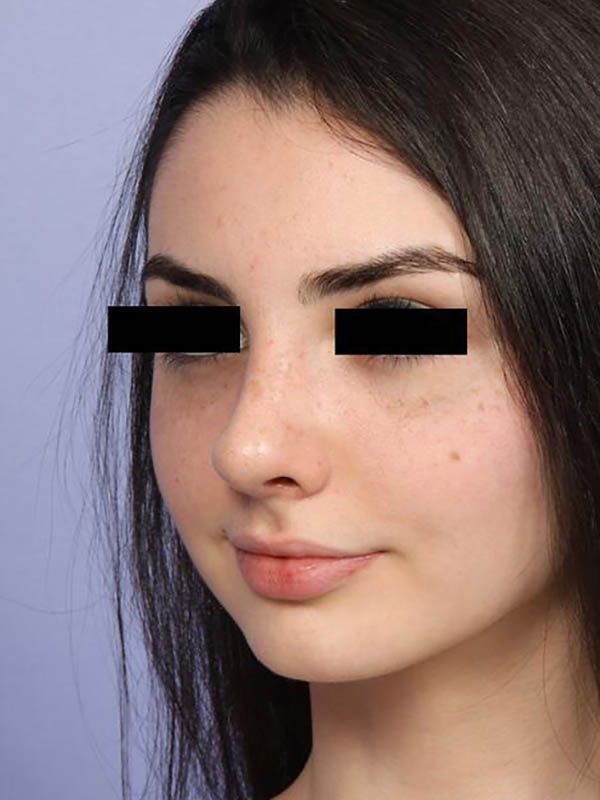 Rhinoplasty Before & After Image