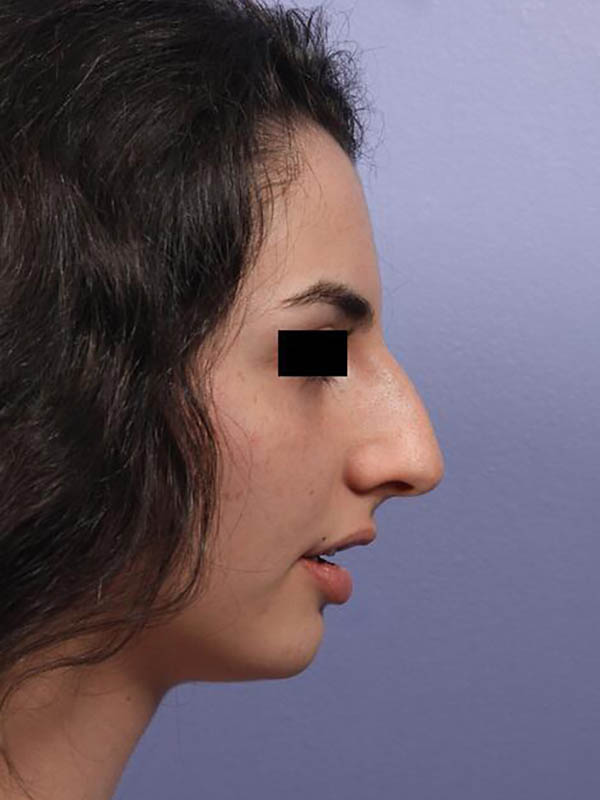 Rhinoplasty Before & After Image