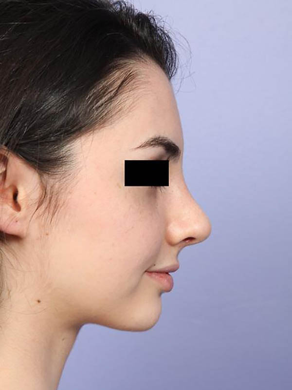 Rhinoplasty Before & After Image