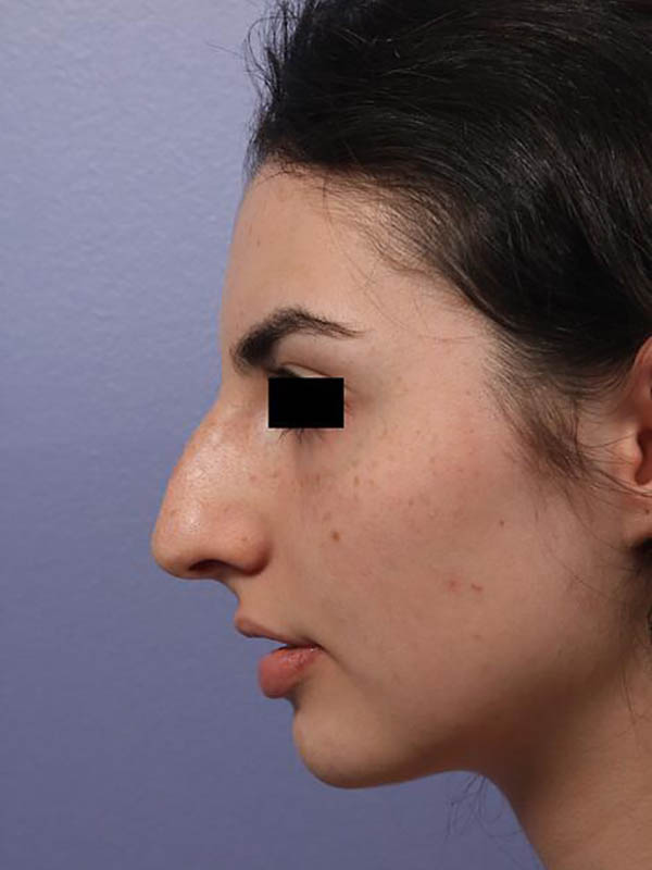 Rhinoplasty Before & After Image