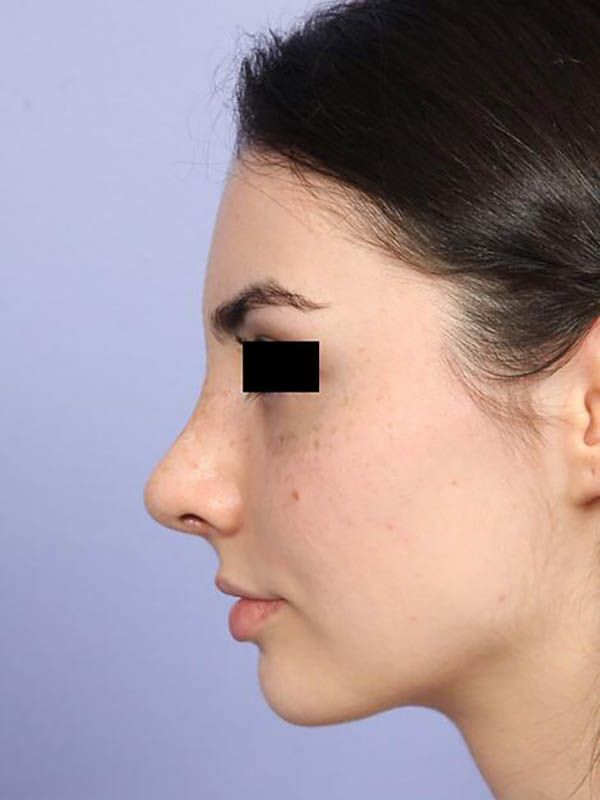 Rhinoplasty Before & After Image