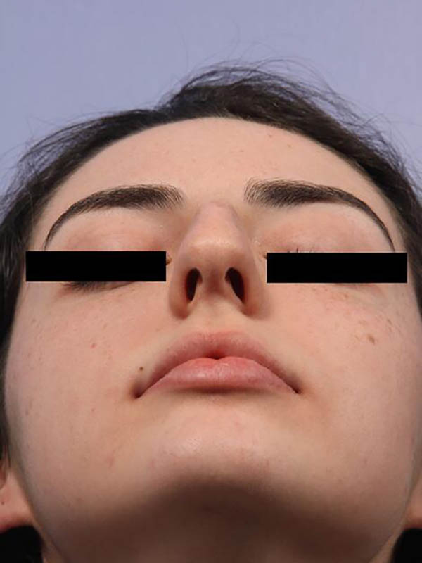 Rhinoplasty Before & After Image