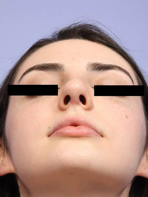 Rhinoplasty Before & After Image