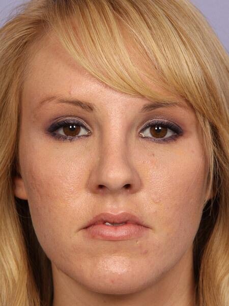 Rhinoplasty Before & After Image