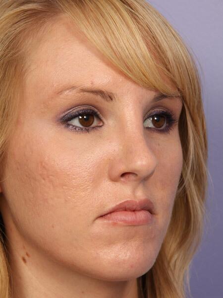 Rhinoplasty Before & After Image