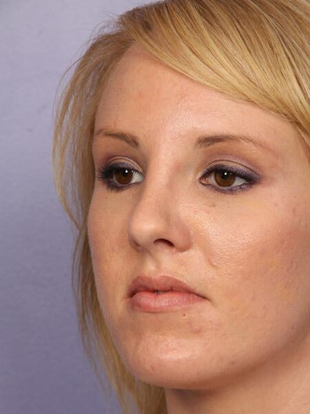 Rhinoplasty Before & After Image