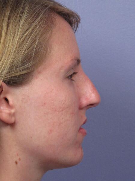 Rhinoplasty Before & After Image