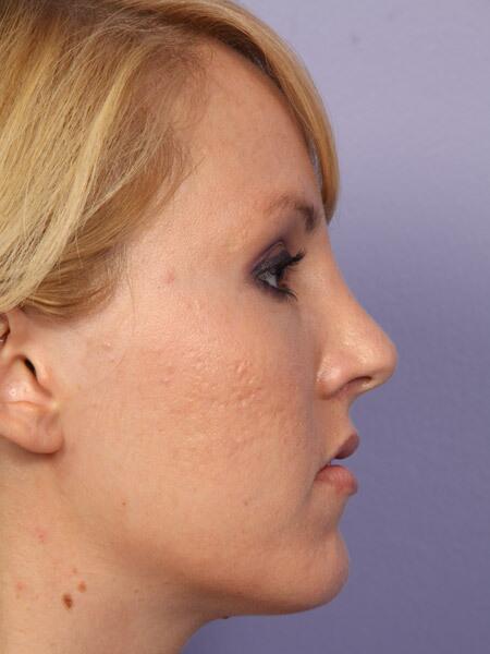 Rhinoplasty Before & After Image