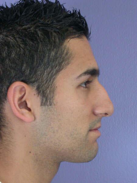 Rhinoplasty Before & After Image