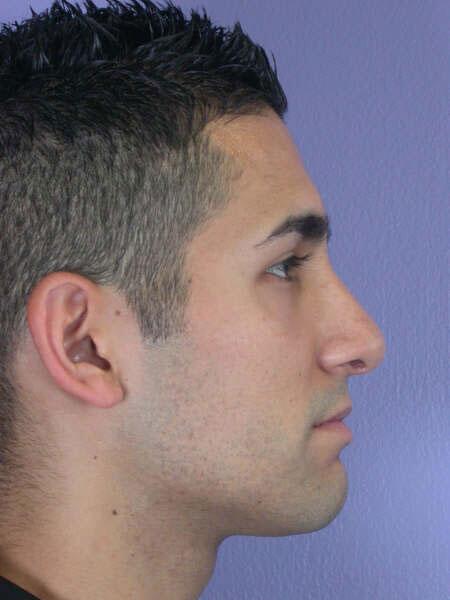 Rhinoplasty Before & After Image