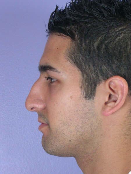 Rhinoplasty Before & After Image