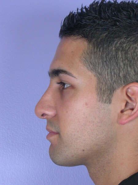 Rhinoplasty Before & After Image